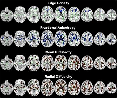 White Matter Connectome Correlates of Auditory Over-Responsivity: Edge Density Imaging and Machine-Learning Classifiers